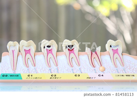 齲病解釋模型 81458113