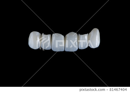 Six upper jaw frontal ceramic crowns prosthesis on black glass background. Artificial jaw with veneers and crowns. 81467404