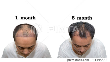 Hair transplantation surgery steps. Patient before and after the procedure. 81495538