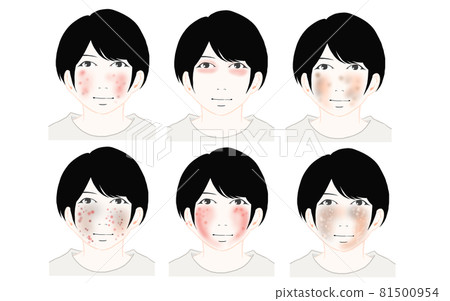 6 illustrations of atopic dermatitis facial cases 6 illustrations of atopic dermatitis facial cases 81500954