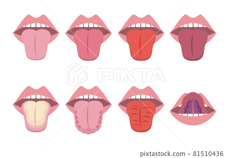 舌診圖解（中醫會診）-插圖素材 [81510436] - PIXTA圖庫