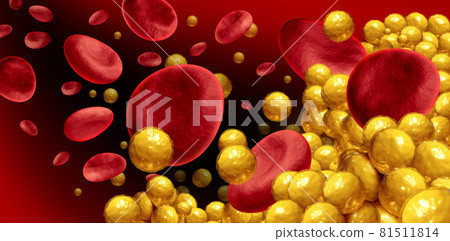 Blocked Artery Blocked Artery 81511814