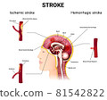 causes of stroke and the development of the disease 81542822