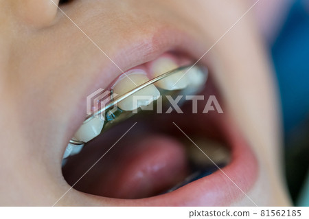 箍牙 牙齒 齒輪 81562185