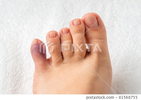 Purple bruise on the little toe of female - Stock Photo