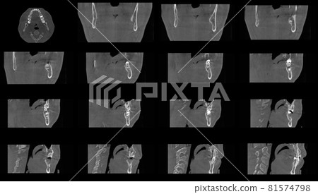 Set of MRI scanner slices of dental part of human male scull with multiple problems on white background. 81574798