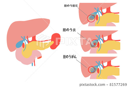Illustration of gall bladder disease 81577269