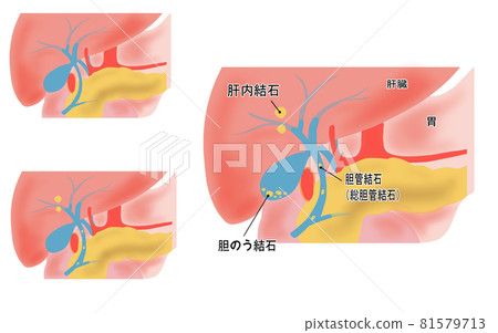 Illustrated illustration of gallbladder stone 81579713