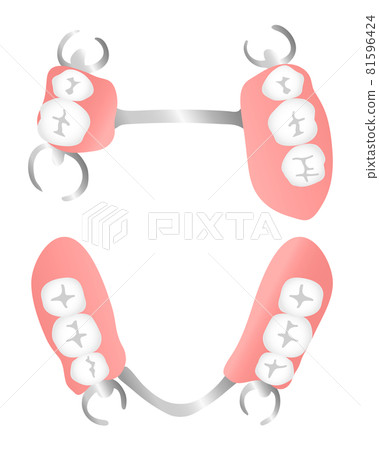 Removable partial denture (occlusal surface) Removable partial denture (occlusal surface) 81596424