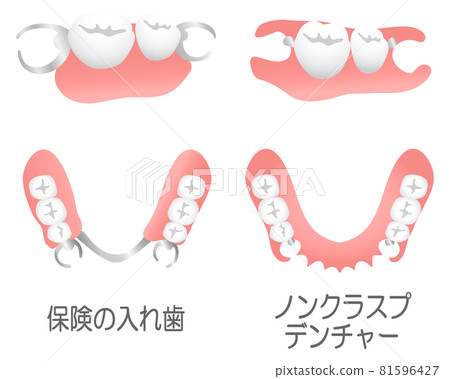 無扣假牙和保險假牙（附文字） 81596427