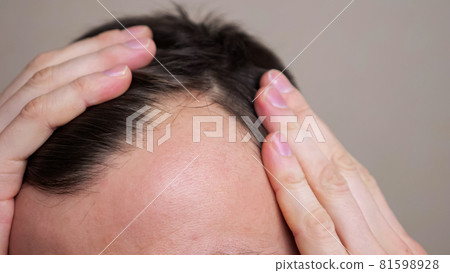 Man with bald spots suffering from hair loss. Treatment of hair problem Man with bald spots suffering from hair loss. Treatment of hair problem 81598928