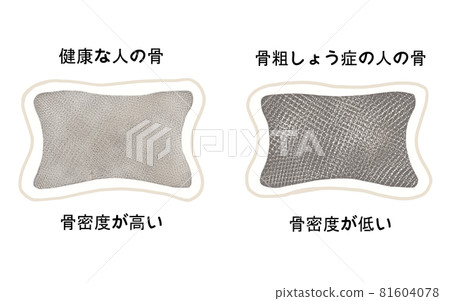 健康骨與骨質疏鬆骨對比圖 81604078