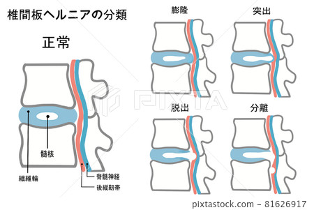 健康椎間盤和突出椎間盤的四種分類圖示 健康椎間盤和突出椎間盤的四種分類圖示 81626917