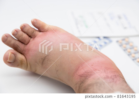 Swollen legs caused by insect bites Swollen legs caused by insect bites 81643195