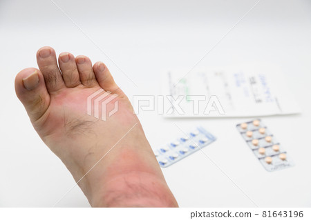 Swollen legs caused by insect bites Swollen legs caused by insect bites 81643196