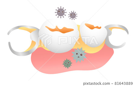 Dirty dentures (partial dentures) 81643889