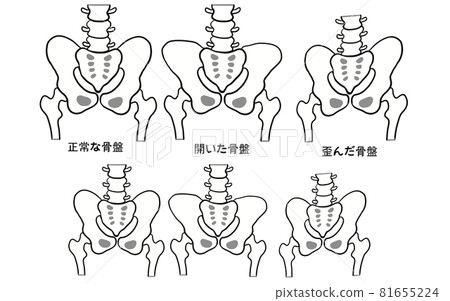 健康骨盆與扭曲骨盆對比圖 健康骨盆與扭曲骨盆對比圖 81655224