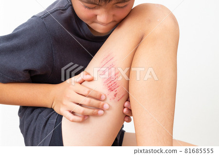 Abrasion of the foot 81685555