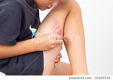 Abrasion of the foot Abrasion of the foot 81685556