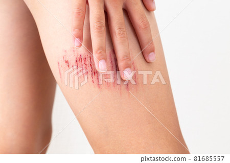 Abrasion of the foot 81685557