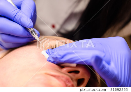 Milium on the face, removal of milia with a syringe in cosmetology. Milium on the face, removal of milia with a syringe in cosmetology. 81692263