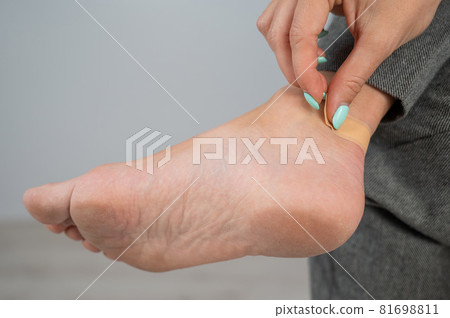 A woman seals a corn on her leg with a plaster. The girl rubbed her leg with uncomfortable shoes. A woman seals a corn on her leg with a plaster. The girl rubbed her leg with uncomfortable shoes. 81698811