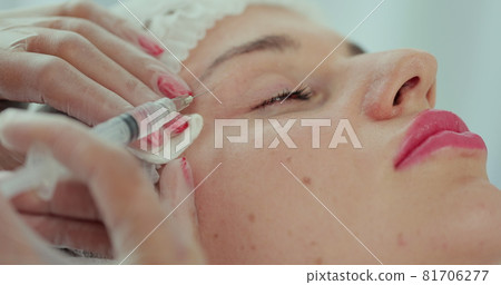 Beautician doctor makes injections into the skin of the face of a young beautiful woman. Face mesotherapy procedure in a beauty salon. Mesotherapy, biorevitalization. Beautician doctor makes injections into the skin of the face of a young beautiful woman. Face mesotherapy procedure in a beauty salon. Mesotherapy, biorevitalization. 81706277