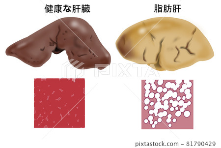 健康肝臟與脂肪肝比較圖 健康肝臟與脂肪肝比較圖 81790429