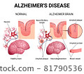 Alzheimer disease and changes in the brain 81790536
