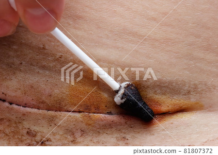 Subcuticular suture surface disinfection with tincture of iodine Subcuticular suture surface disinfection with tincture of iodine 81807372