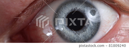 Closeup of diseased eye with red dilated vessels 81809240