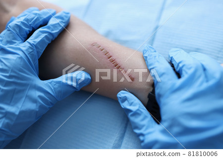Doctor surgeon in protective medical gloves examining scar on patient hand closeup 81810006
