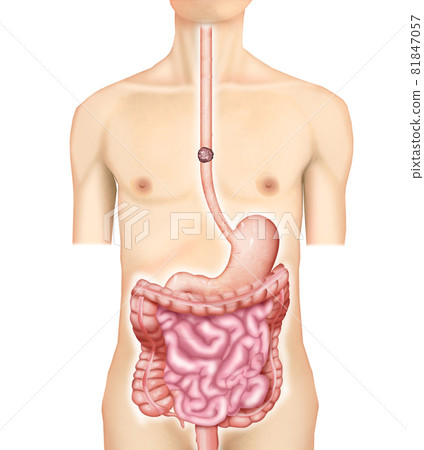 插圖素材：食道癌、胃管、升結腸、重建001（實景） 81847057