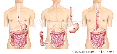 Illustration material: Esophageal cancer, ascending colon, reconstruction Illustration material: Esophageal cancer, ascending colon, reconstruction 81847268
