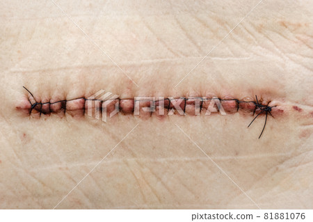 Postoperative suture on human skin 81881076