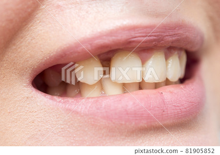 Woman teeth 81905852