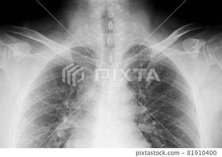 胸部 X 光檢查 81910400