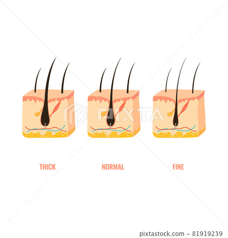 Hair width structure in skin cross-section diagram 81919239