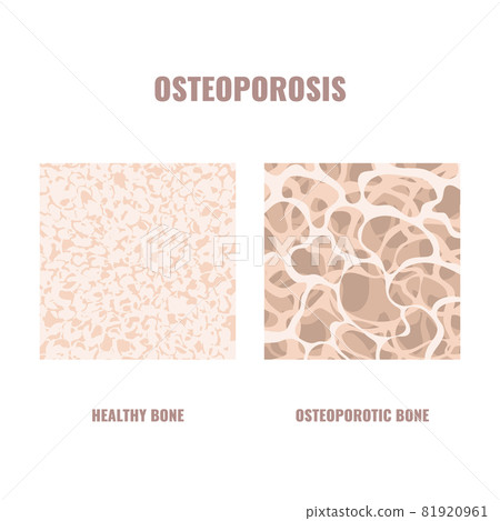 Osteoporosis bone density loss disease medical infographics 81920961