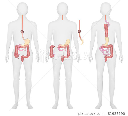 Illustration material: Esophageal cancer, residual stomach, ascending colon, reconstruction Illustration material: Esophageal cancer, residual stomach, ascending colon, reconstruction 81927690