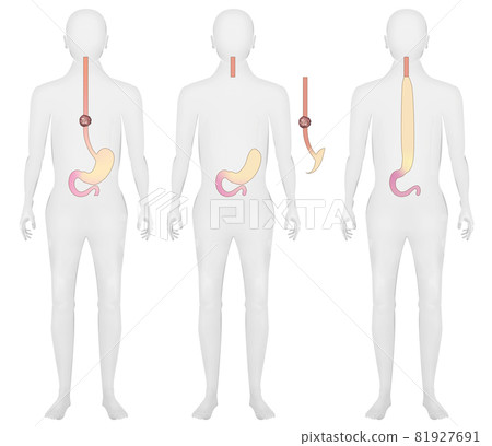 Illustration material: Esophageal cancer / gastric tube / reconstruction Illustration material: Esophageal cancer / gastric tube / reconstruction 81927691