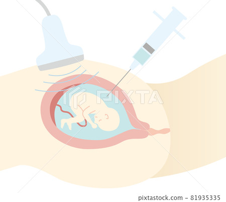 Prenatal diagnosis, amniocentesis, flat taste 81935335