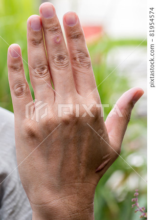 Paronychia, swollen finger inflammation due to bacterial infection on a man hand. Paronychia, swollen finger inflammation due to bacterial infection on a man hand. 81954574