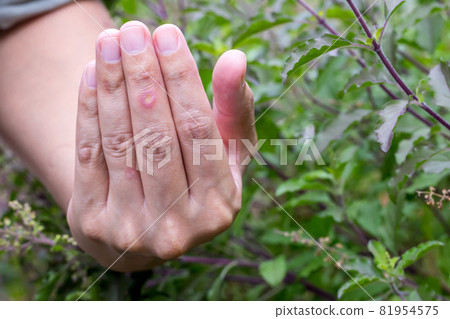 Paronychia, swollen finger inflammation due to bacterial infection on a man hand.  81954575