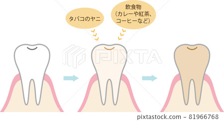 牙齒上有色污漬的插圖 81966768