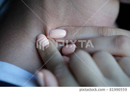 Woman squeezing white pimple on her neck closeup 81990559