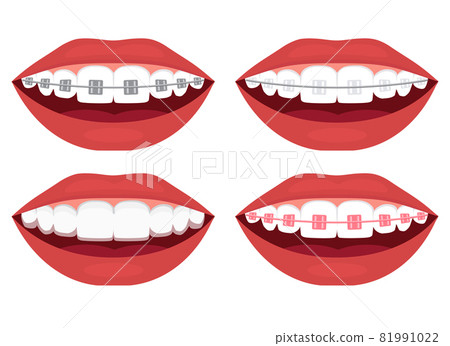 teeth alignment. Metal, ceramic, plastic, ligature and invisible braces 81991022