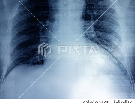 Film X-ray of breast a person Film X-ray of breast a person 81991989