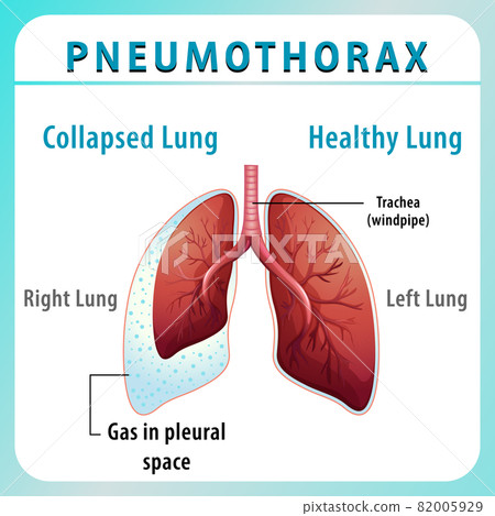 Pneumothorax diagram with collapsed lung and healthy lung Pneumothorax diagram with collapsed lung and healthy lung 82005929