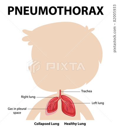 Pneumothorax diagram of human anatomy 82005933